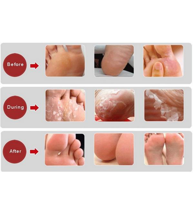 Pedi Peel